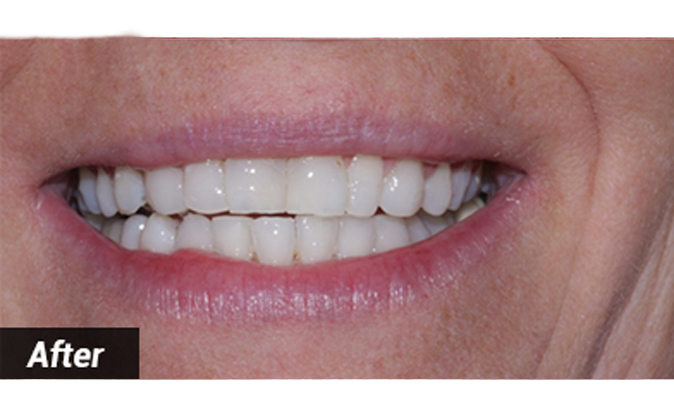 After - Westcountry Dental and Implant Centre