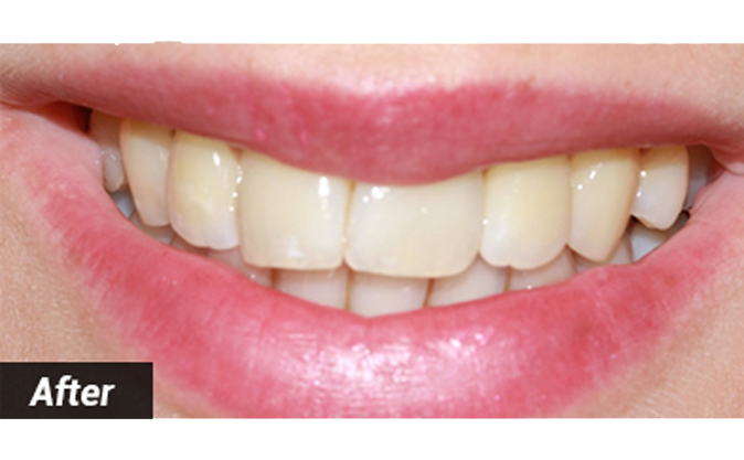 After - Westcountry Dental and Implant Centre