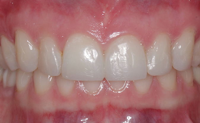 After - Westcountry Dental and Implant Centre