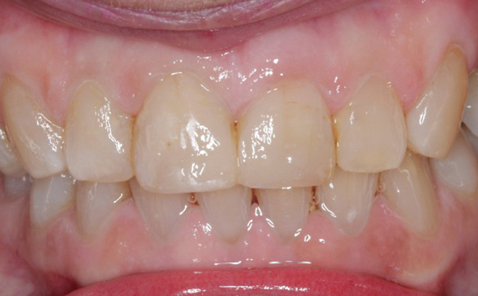 After - Westcountry Dental and Implant Centre