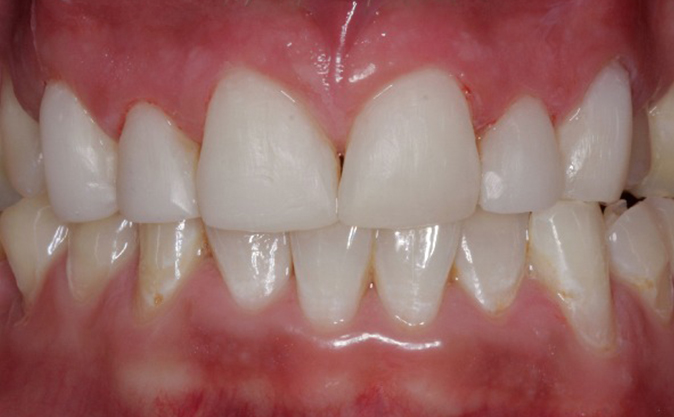 After - Westcountry Dental and Implant Centre
