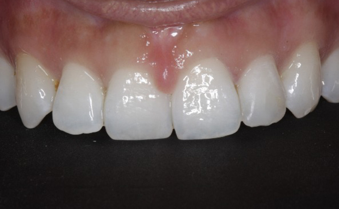 After - Westcountry Dental and Implant Centre