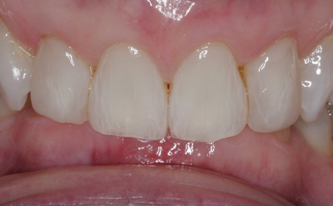 After - Westcountry Dental and Implant Centre