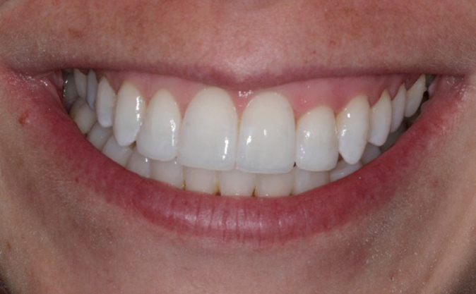 After - Westcountry Dental and Implant Centre