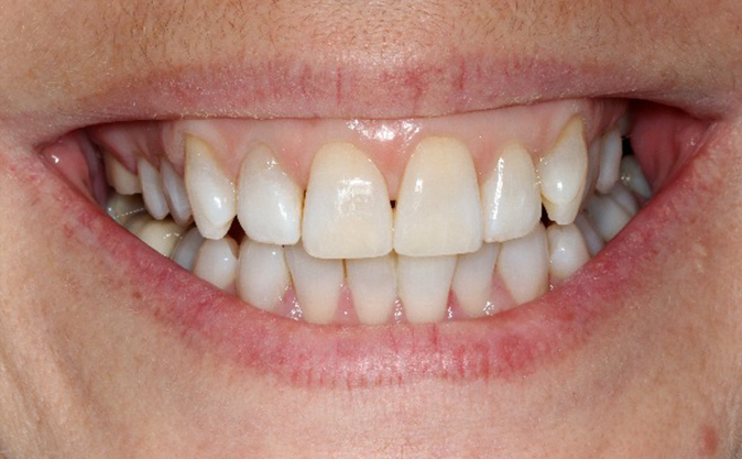 After - Westcountry Dental and Implant Centre