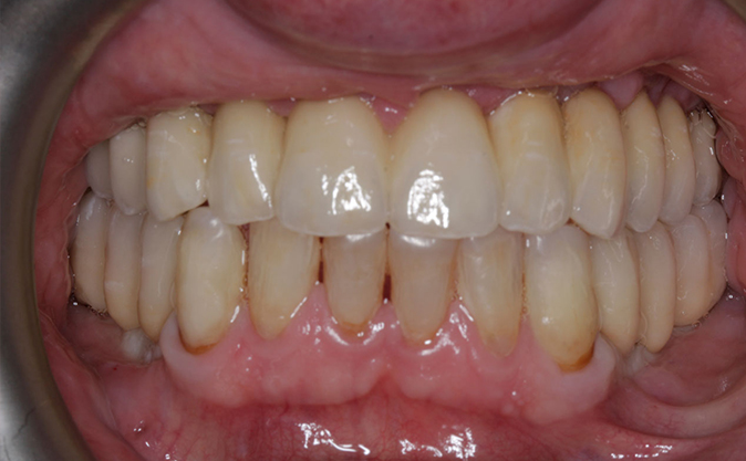 After - Westcountry Dental and Implant Centre