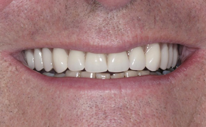 After - Westcountry Dental and Implant Centre