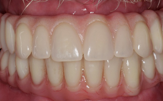 After - Westcountry Dental and Implant Centre