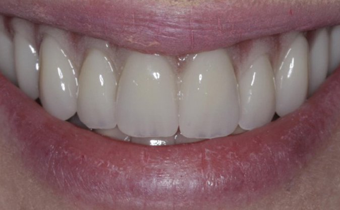 After - Westcountry Dental and Implant Centre