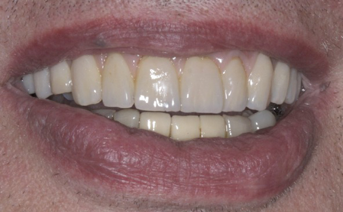 After - Westcountry Dental and Implant Centre