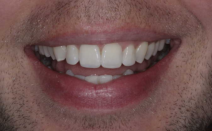 After - Westcountry Dental and Implant Centre