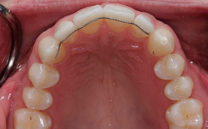 After - Westcountry Dental and Implant Centre