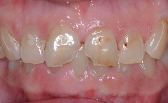 Before - Westcountry Dental and Implant Centre