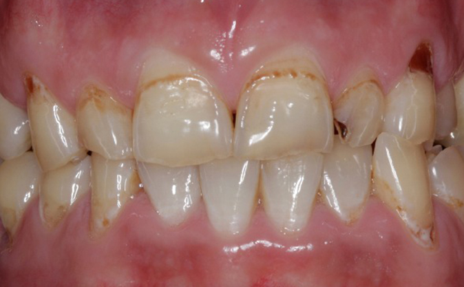 Before - Westcountry Dental and Implant Centre