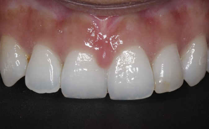 Before - Westcountry Dental and Implant Centre