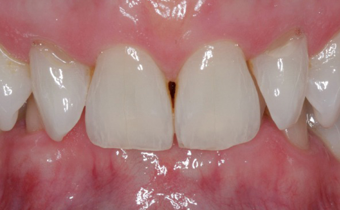 Before - Westcountry Dental and Implant Centre