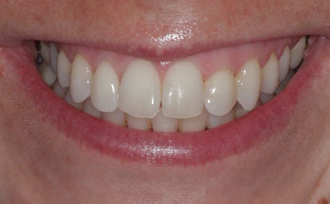 Before - Westcountry Dental and Implant Centre