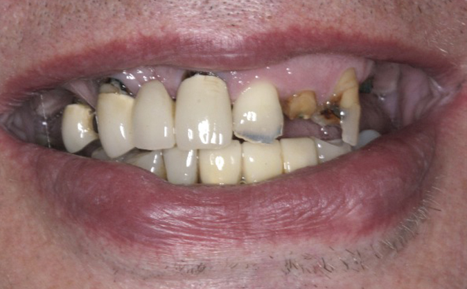 Before - Westcountry Dental and Implant Centre