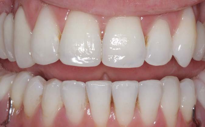 After - Westcountry Dental and Implant Centre
