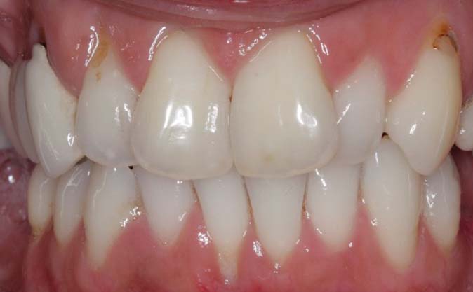 Before - Westcountry Dental and Implant Centre