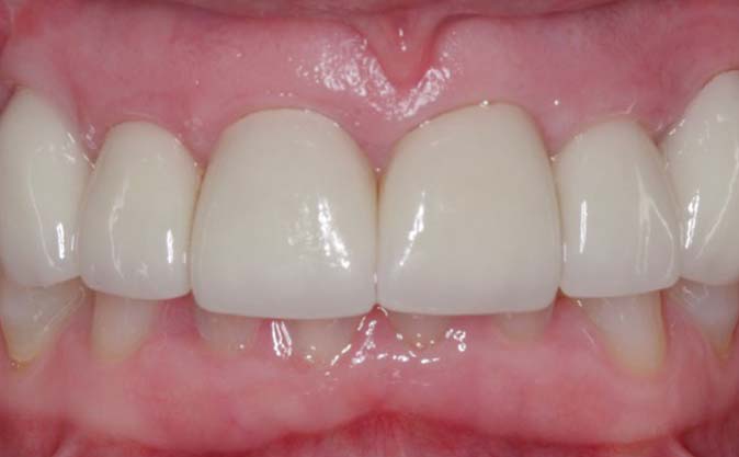 After - Westcountry Dental and Implant Centre