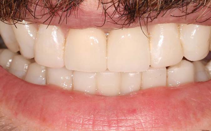 After - Westcountry Dental and Implant Centre