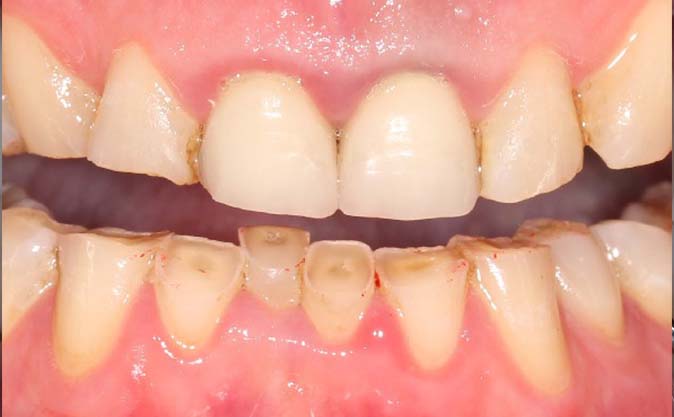 Before - Westcountry Dental and Implant Centre