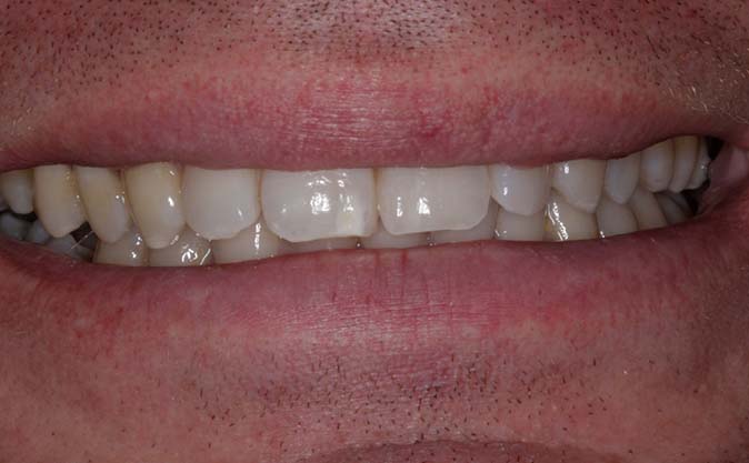 After - Westcountry Dental and Implant Centre