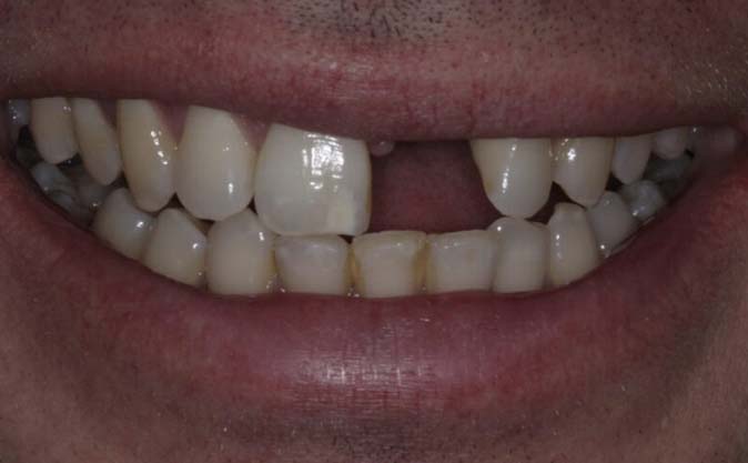 Before - Westcountry Dental and Implant Centre