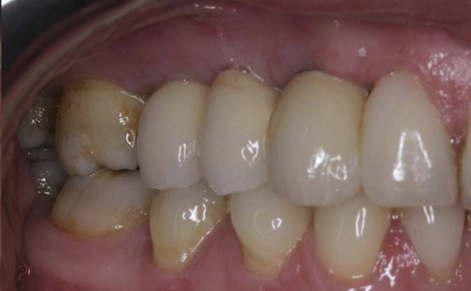 After - Westcountry Dental and Implant Centre