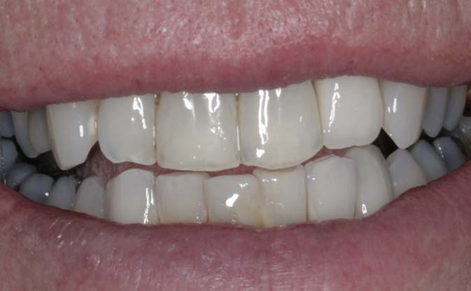 After - Westcountry Dental and Implant Centre