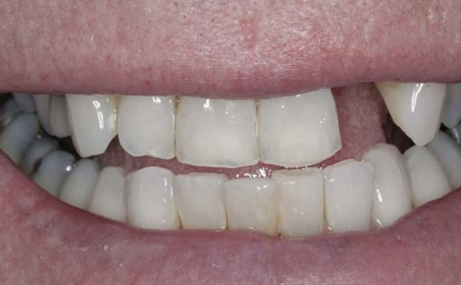 Before - Westcountry Dental and Implant Centre