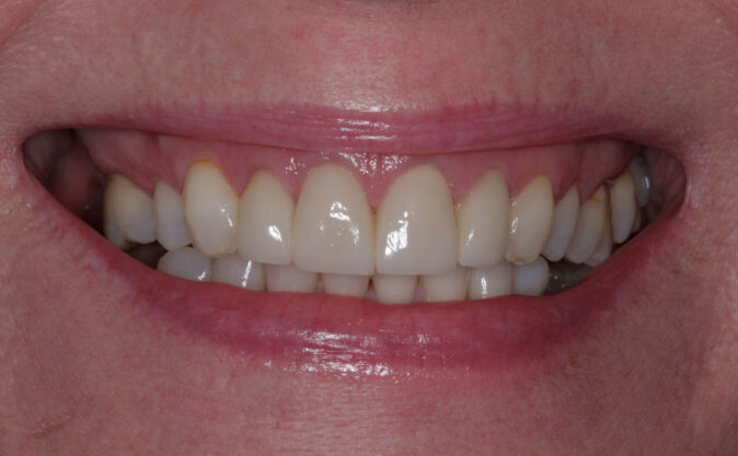 After - Westcountry Dental and Implant Centre