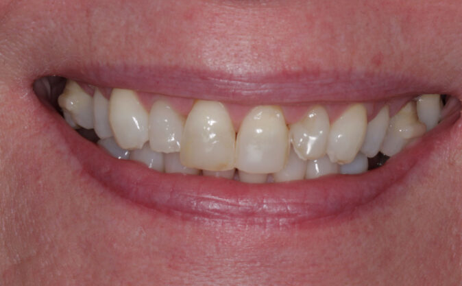 Before - Westcountry Dental and Implant Centre
