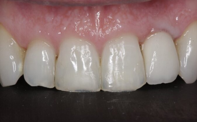 After - Westcountry Dental and Implant Centre