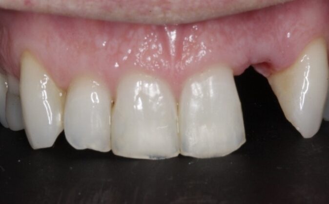 Before - Westcountry Dental and Implant Centre