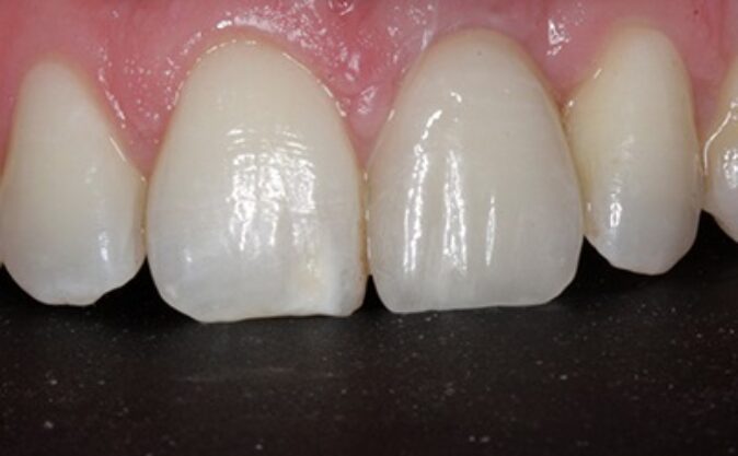 After - Westcountry Dental and Implant Centre