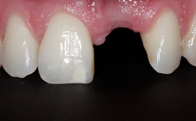 Before - Westcountry Dental and Implant Centre