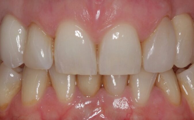 After - Westcountry Dental and Implant Centre