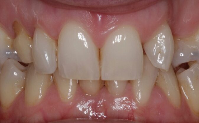 Before - Westcountry Dental and Implant Centre