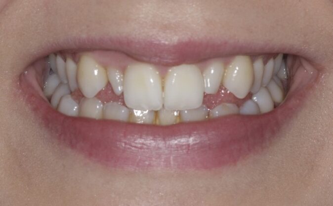 Before - Westcountry Dental and Implant Centre