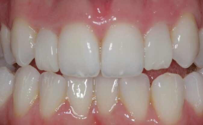After - Westcountry Dental and Implant Centre
