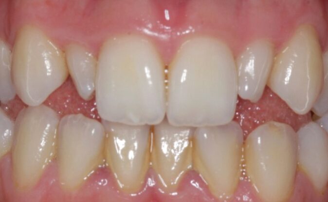 Before - Westcountry Dental and Implant Centre