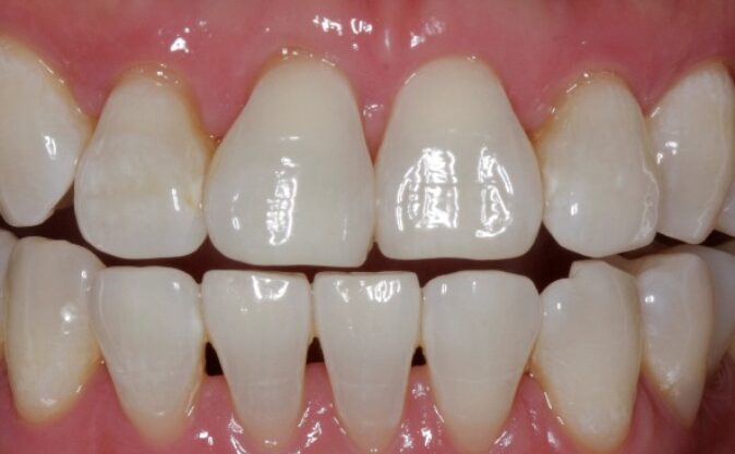 After - Westcountry Dental and Implant Centre