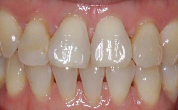 Before - Westcountry Dental and Implant Centre