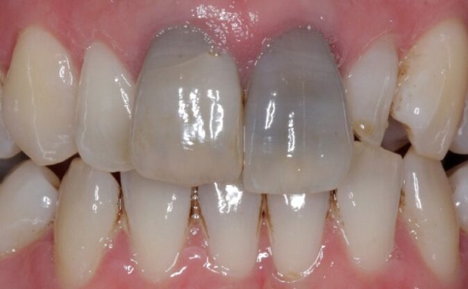 Before - Westcountry Dental and Implant Centre