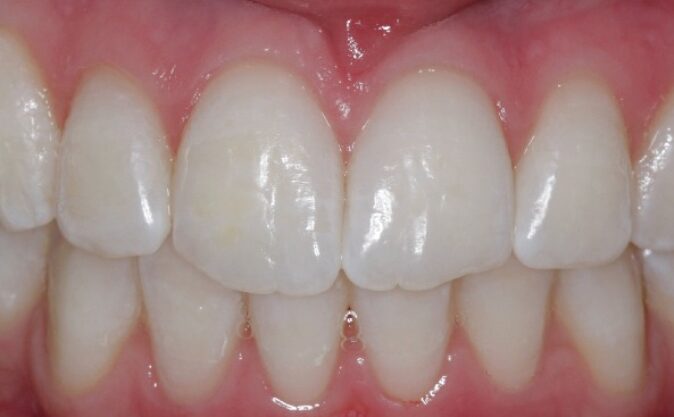 After - Westcountry Dental and Implant Centre