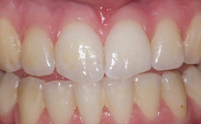 Before - Westcountry Dental and Implant Centre