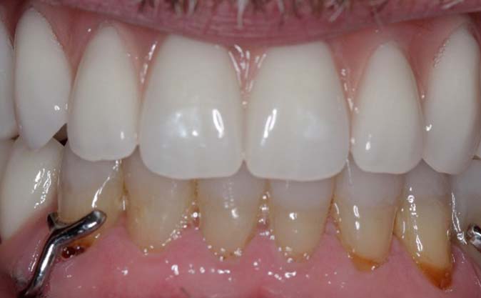 After - Westcountry Dental and Implant Centre