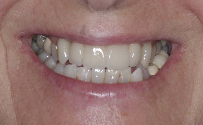 After - Westcountry Dental and Implant Centre